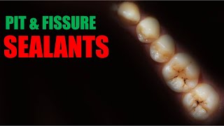 Pit and fissure sealants [upl. by Mcclary]