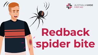 Redback Spider Bite  First Aid [upl. by Haynor]