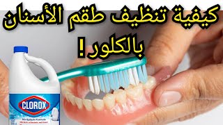 تنظيف طقم الأسنان المتحرك بالكلور  الجافيل   Javel pour nettoyer prothèse dentaire amovible [upl. by Brand897]