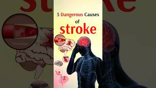 5 Dangerous Causes of stroke shorts [upl. by Letsyrhc]