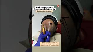 Mesoterapia Capilar Mesoterapia con Dutasteride para alopecia mesoterapia hair cabello salud [upl. by Bensen]