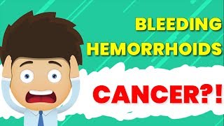 Can Hemorrhoids Be A Sign of Cancer  Best Hemorrhoids amp Piles Answers [upl. by Enelrak]