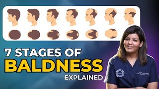 Understanding Hair Loss Stages A Comprehensive Guide to Scalp Assessment and Treatment Options [upl. by Row]