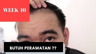 10 WEEKS AFTER HAIR TRANSPLANT TURKEY [upl. by Atwahs]