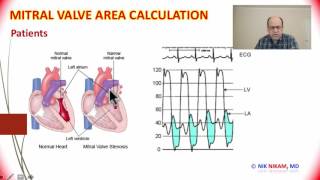 Heart Valves  Mitral Valve Area Calculation by Cath  Dr NIK NIKAM [upl. by Samaj945]