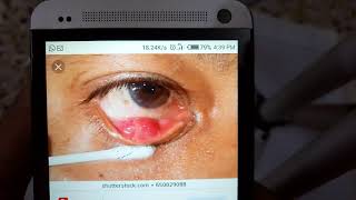 EYELIDS lecture 7 PTOSIS and TUMORS OF EYELIDS in easiest way with all important things [upl. by Adin]