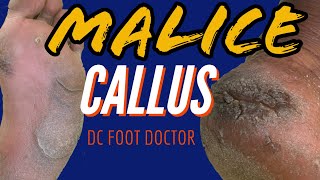 Malice Callus Severe Calluses and Fissures Size 13 Feet [upl. by Chane704]