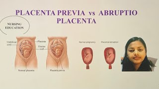 PLACENTA PREVIA VS ABRUPTIO PLACENTA FOR NCLEX EXAM AND NURSES USRN USNURSE [upl. by Pilif]