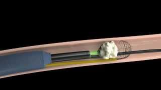 Calculo Renal Tratamiento mediante fragmentacion interna Urologia Peruana [upl. by Gothart117]