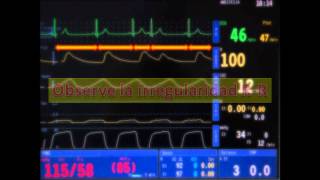 Arritmia sinusal respiratoria [upl. by Redienhcs]