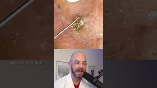 Derm reacts to massive blackhead removal dermreacts doctorreacts blackheadextraction [upl. by Ecirtel983]