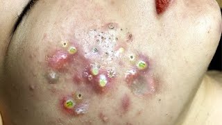 Big Cystic Acne Blackheads Extraction Blackheads amp Milia Whiteheads Removal Pimple Popping  6807 [upl. by Oilla525]