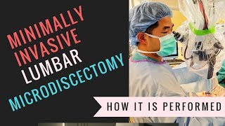 Minimally Invasive Lumbar Microdiscectomy Video  How Its Performed [upl. by Enelrahc226]