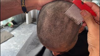 How to get rid old dandruff flakes scratching super care 🥵😱💯 how to get rid of dry scaly skin [upl. by Yaluz]