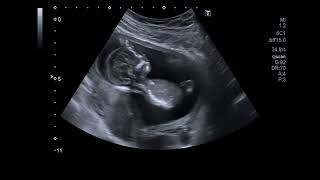 Beautiful Ultrasound Video of 14 Weeks Pregnancy Baby Girl [upl. by Derrej124]