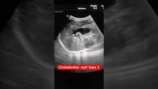 Choledochal cyst type I [upl. by Eulau]