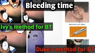 blood Bleeding time test Dukes and Ivy’s method blood coagulation profile lecture 2 [upl. by Bopp]