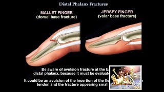 Distal Phalanx Fractures  Everything You Need To Know  Dr Nabil Ebraheim [upl. by Aindrea]