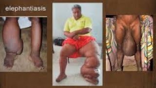 Comment soigner naturellement l’ELEPHANTIASIS [upl. by Koser]