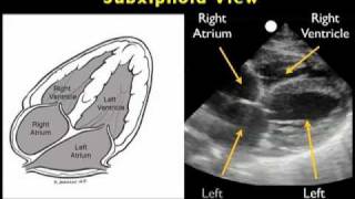 How to Echocardiography  Subxiphoid View [upl. by Assilanna]