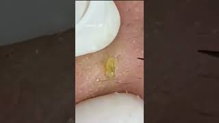 Pickel Ausdrücken Spa  Blackheads Akne amp Mitesser entfernen 🔴 17 [upl. by Madox]