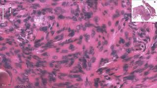 Meningioma  Histopathology [upl. by Berg259]