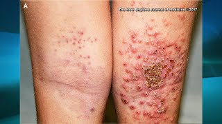 What You Need to Know if You Have Eczema [upl. by Ettennil]