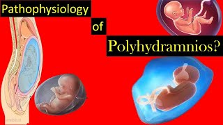 Pathophysiology of Polyhydramnios During Pregnancy [upl. by Newnorb]