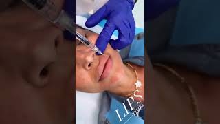 Get Fuller Lips Fast Top Lip Fillers in Dubai  EDEN AESTHETICS Clinic [upl. by Yziar]