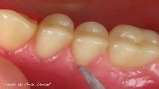 3  🔴 DEFINICIÓN DE CUELLOS 🔴 en Protesis total dental ARMONIA [upl. by Htomit]