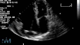 Arrhythmogenic right ventricular dysplasia [upl. by Tronna]