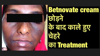 Betnovate c cream side effects  Steroid Cream से काले हुए चेहरे का Treatment [upl. by Luar]