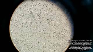 Misdiagnosed disseminated strongyloidiasis case  Supplementary video 1 ID 381298 [upl. by Meisel468]