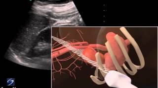 3D How To Left Kidney Ultrasound  SonoSite Ultrasound [upl. by Sidonie]