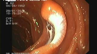 lactocele duodenal [upl. by Acimahs]