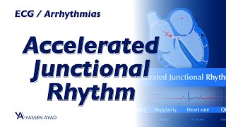 ECG 55  Accelerated Junctional Rhythm [upl. by Vivica757]