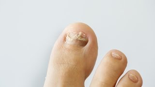 How to prevent and treat nail fungus [upl. by Adiaros]