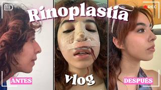 Me operé la nariz RINOPLASTIA Vlog  mi experiencia [upl. by Carol]