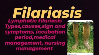 FilariasisSign and Symptomscausesrisk factors Incubation period Nursing management of filaria [upl. by Airreis]