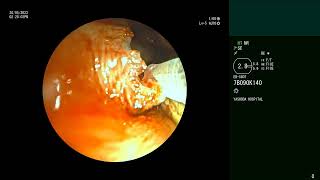 Adenoid cystic carcinoma of Trachea  Silicone Y stent  Complications Bronchoscopic management [upl. by Breskin529]