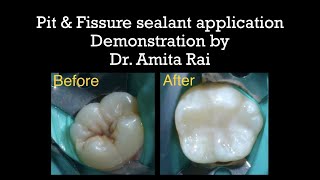 Pit amp Fissure sealant application Demonstration by Dr Amita Rai [upl. by Ayenat]