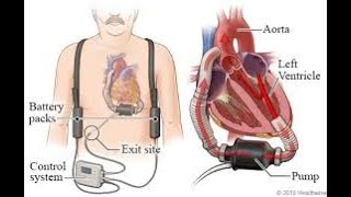 VENTRICULAR ASSIST DEVICES [upl. by Leirraj]