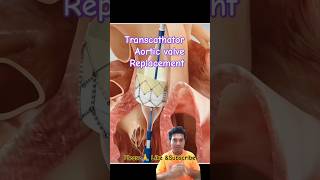 Aortic Valve Replacement animation satisfying cardiology viral aorticvalve shorts [upl. by Willman808]