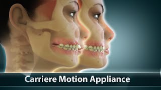 Carriere Motion Orthodontic Treatment  Curveia Dental Animation  Patient Education Video [upl. by Aimal]