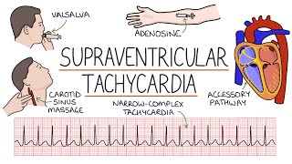 Understanding Supraventricular Tachycardia SVT [upl. by Boote176]