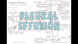 Pleural Effusion DETAILED  pathophysiology signs and symptoms treatment [upl. by Murielle]