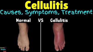 Cellulitis Symptoms Causes Treatment amp Prevention [upl. by Lacie]