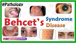 Behçet’s SyndromeBehcet Disease  Causes Pathology Clinical presentation Diagnosis and Treatment [upl. by Hinda]