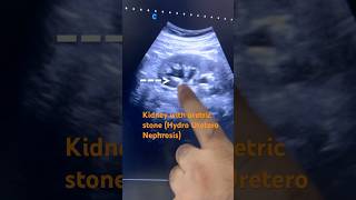 Kidney Ultrasound  kidneyhealth bestultrasound kidneystone ytshorts yt short doctor [upl. by Yadsnil]