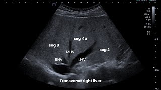 Ultrasound Abdomen Liver Segments Clips and Questions [upl. by Gatian]